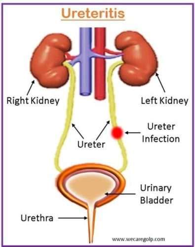 Ureteritis: Causes, Symptoms, Management - We Care