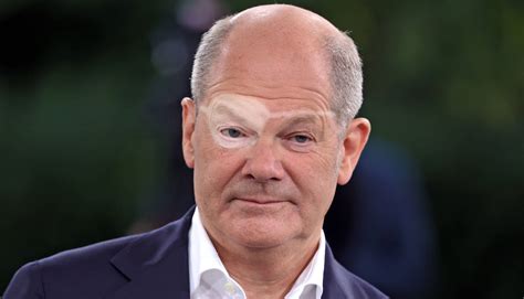 Exklusiv: Hier ist das erste Foto von Olaf Scholz ohne Augenklappe