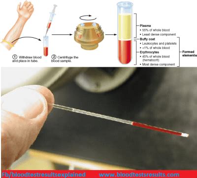 What is Hematocrit (HCT) in CBC test results? - Blood Test Results ...