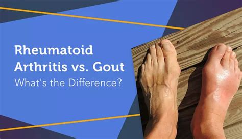 Rheumatoid Arthritis vs. Gout: What Is the Difference? | myRAteam