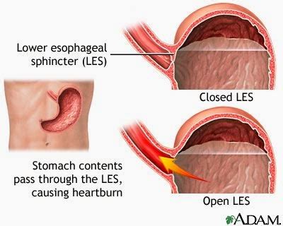 ENFERMERÍA - NURSING: DYSPEPSIA, GERD, IBS AND DIVERTICULAR DISEASE