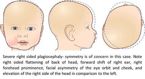 Plagiocephaly Helmet