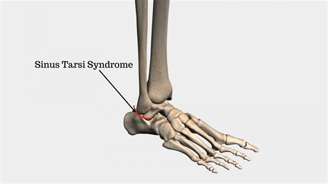 Sinus Tarsi Syndrome | How to treat Sinus Tarsi Syndrome