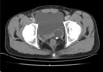 Ureteral Triplication Associated with Ipsilateral Ureterocele and ...