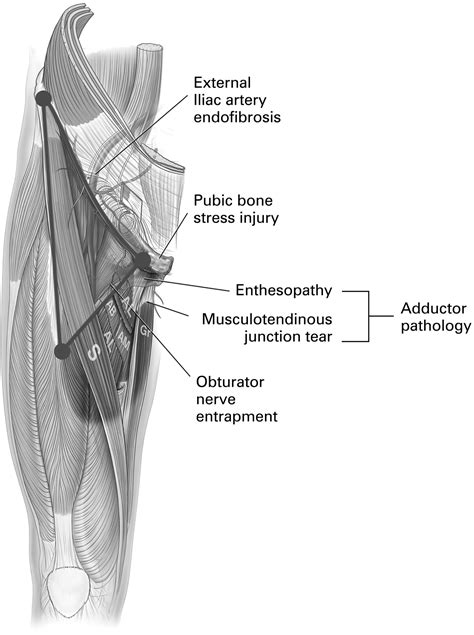 The groin triangle: a patho-anatomical approach to the diagnosis of chronic groin pain in ...