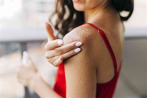 Heat Rash: Signs and Symptoms