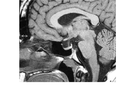 Sagittal MRI showing empty sella (case 1) | Download Scientific Diagram