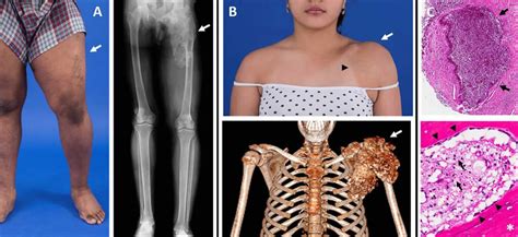 Tumoral calcinosis, definition, causes, symptoms, diagnosis & treatment