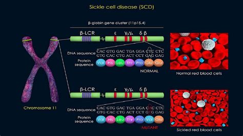 Sickle Cell Anemia Mutation