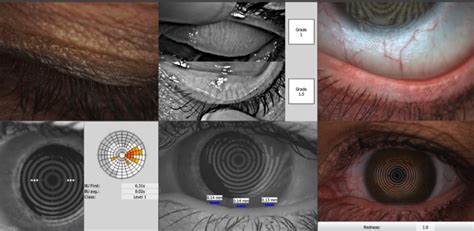 Dry eye and cosmetics: a clinical experience