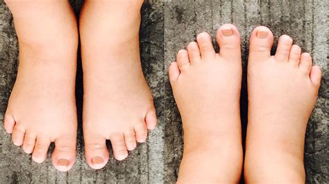 Swollen Feet During Pregnancy: Natural Remedies