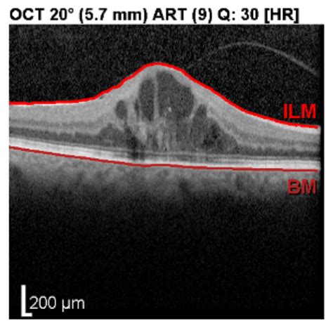 Diabetic macular edema