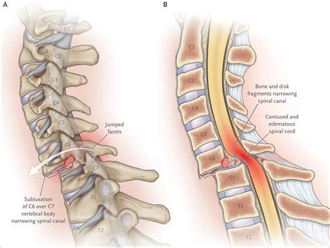 Spinal Cord Compression | NEJM Resident 360