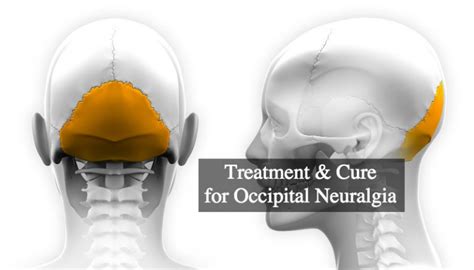 Treatment & Cure for Occipital Neuralgia