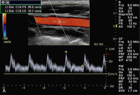 Doppler Flow Imaging and Spectral Analysis | Radiology Key