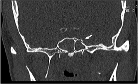 Computed tomography image in cronal view showing sphenoid bone fracture. | Download Scientific ...