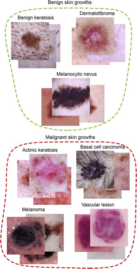 Sample images for different types of skin lesions. | Download Scientific Diagram