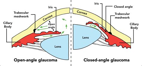 Types Of Glaucoma Openangle And Angleclosure Glaucoma - vrogue.co