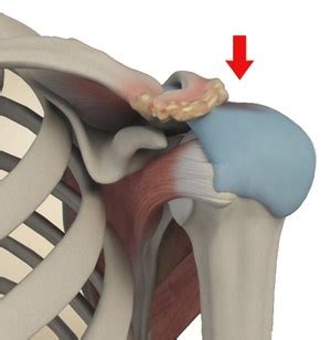 Arthroscopic Subacromial Decompression Denver | Shoulder Impingement Denver