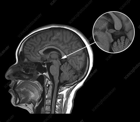 Healthy pineal gland, MRI scan - Stock Image - C055/1825 - Science ...