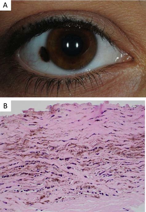 Blue Nevus Histology