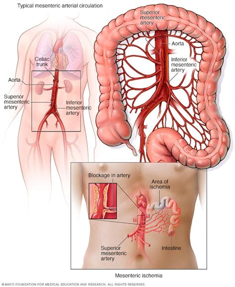 Mesenteric ischemia - Symptoms and causes - Mayo Clinic