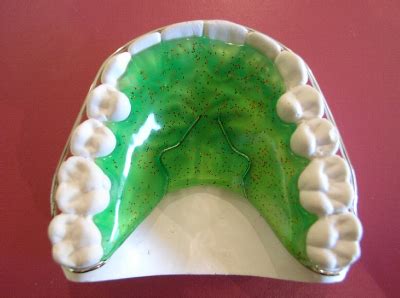 Orthodontic Retainers - Smiles Orthodontic Practice