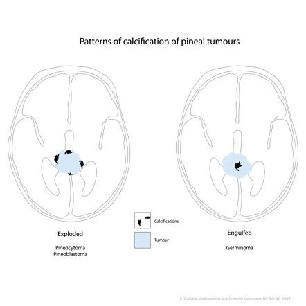 Pineal Gland Calcification