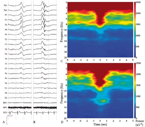 The K-complex and the epileptic K-complex: Raw EEG of a KC (A) and an ...