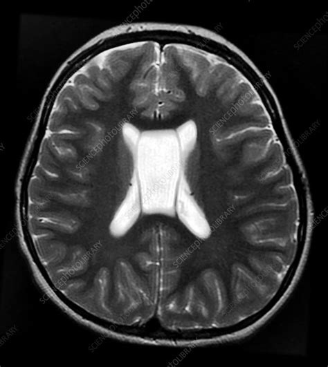 MRI Cavum Septum Pellucidum et Vergae - Stock Image - C043/0388 - Science Photo Library