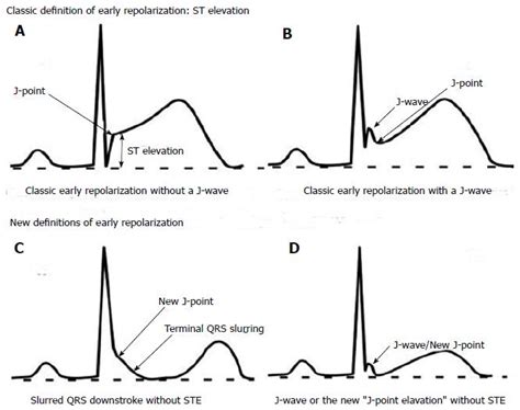 Early repolarization syndrome - Cardiology Outlines