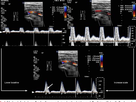 Figure 6 from Doppler ultrasonography of the lower extremity arteries ...