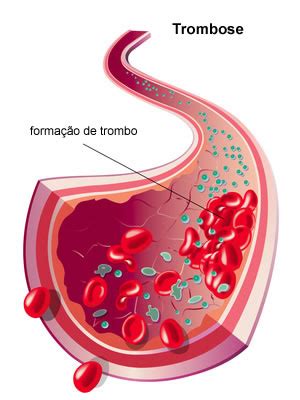 Thrombose : causes, symptômes & traitements | Creapharma