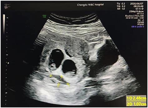 Frontiers | The risk factors and impact of subchorionic hematoma in the ...