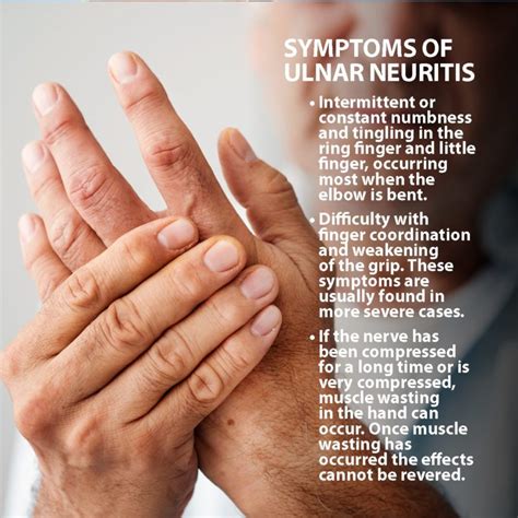 Ulnar Neuritis Information | Florida Orthopaedic Institute