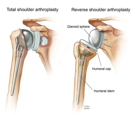 How Long Does Shoulder Replacement Recovery Takes?