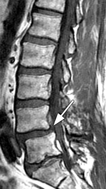 Spondylolisthesis, Spondylolysis | Radsource