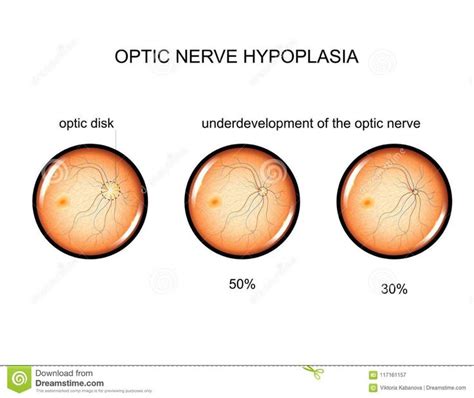 Pin von Georgia Laudenslager auf Optic Nerve Hypoplasia (ONH)