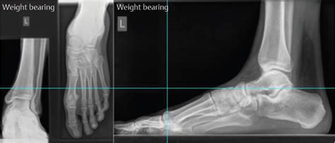 Subtalar Joint Fusion | Musculoskeletal Key