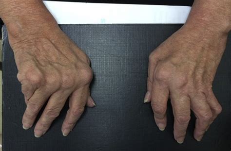 Understanding and Managing Hand Deformities in Rheumatoid Arthritis - Becker Spine