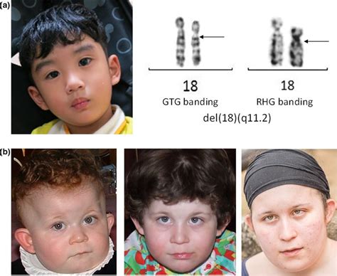 (a) Patient 1. Facial profile at age 3 years (left panel). Chromosome ...