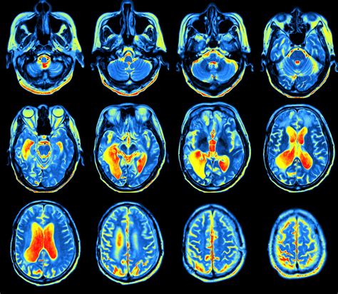 Imaging Tracer with Potential to Bolster Parkinson's Clinical Trials ...