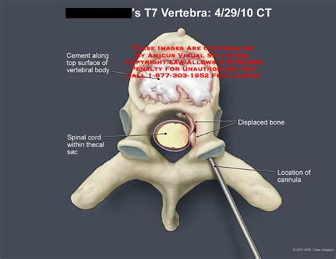 T7 Vertebra