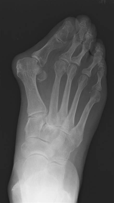 Hallux valgus - Radiology at St. Vincent's University Hospital