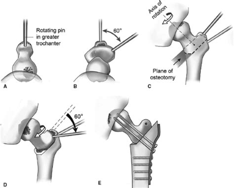 Proximal Femoral Osteotomy