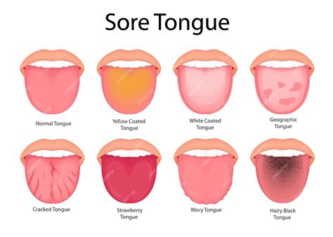 Healthy Tongue Pictures Vs Unhealthy