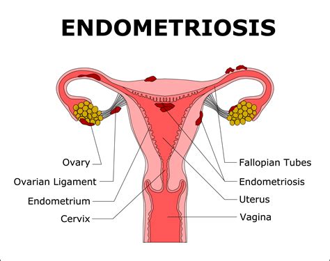 Blocked Fallopian Tube: Symptoms, Causes and Treatment