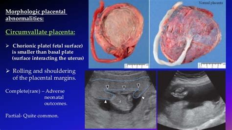 Succenturiate Lobe Placenta Ultrasound