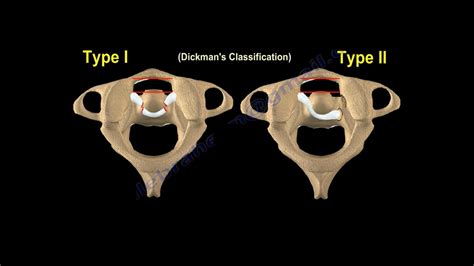 Transverse Ligament Injury of Cervical spine — OrthopaedicPrinciples.com