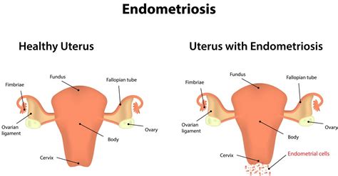 In Endometriosis Study, Enzyme Found to Regulate Hormone-Dependent Migration of Cells ...